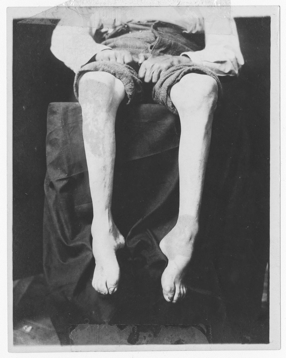 Image of a patient's legs with chronic anterior poliomyelitis, Source: Historical Medical Library of the College of Physicians of Philadelphia