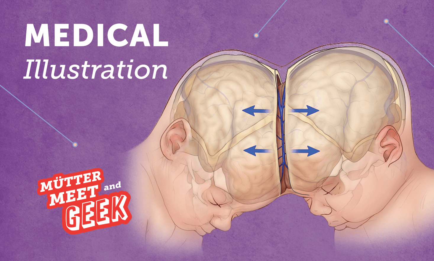 Purple background, illustration of two infants conjoined at the head, diagram of their brains visible. Text that says "Mütter Meet and Geek: Medical Illustration"