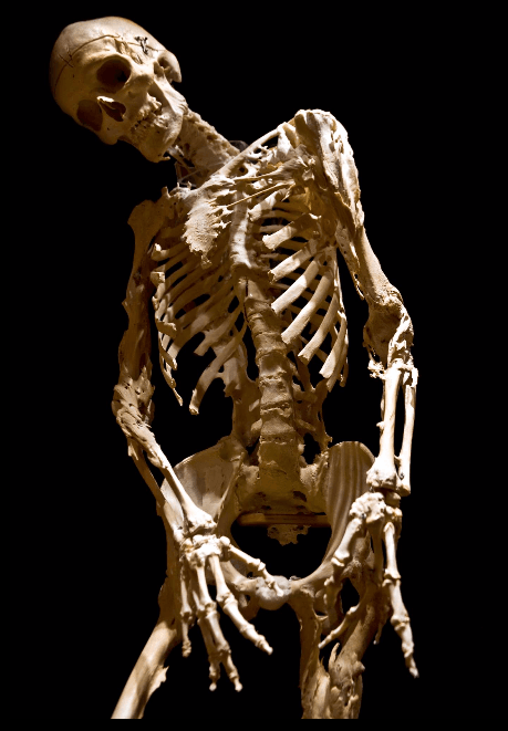 HarryEastlackSkeleton