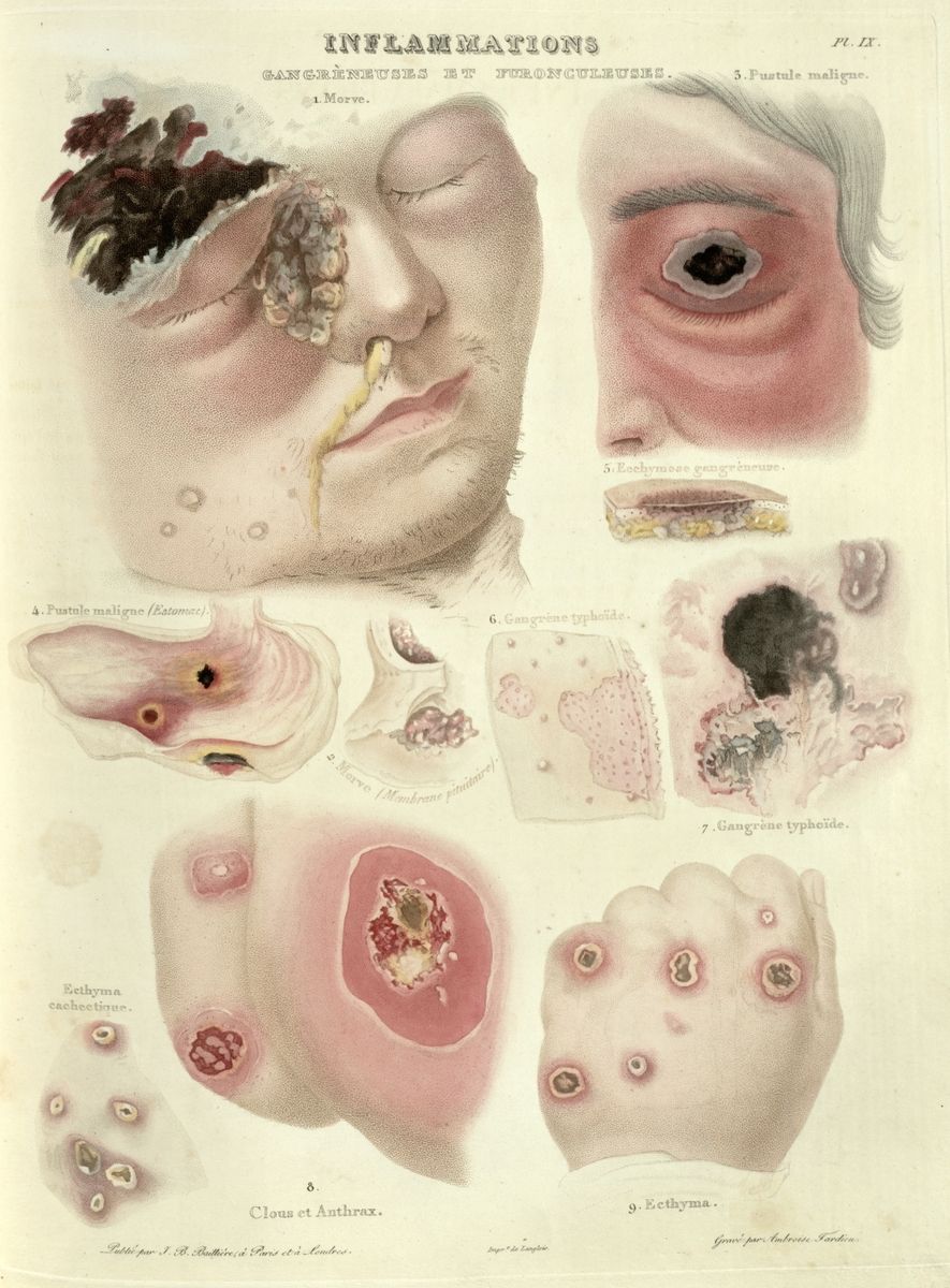 Depictions of gangrene's progress from an 1835 book Source: Historical Medical Library of the College of Physicians of Philadelphia